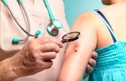 feed-image-1788707165-4 Microplásticos são mais frequentes em pulmões de pacientes com câncer