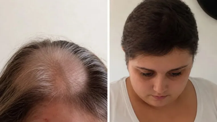 feed-image-1789604009 Mulher fez quimioterapia por 11 anos e descobriu que nunca teve câncer