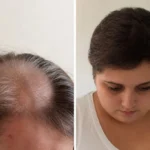 Mulher fez quimioterapia por 11 anos e descobriu que nunca teve câncer