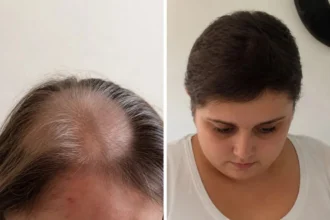 Mulher fez quimioterapia por 11 anos e descobriu que nunca teve câncer