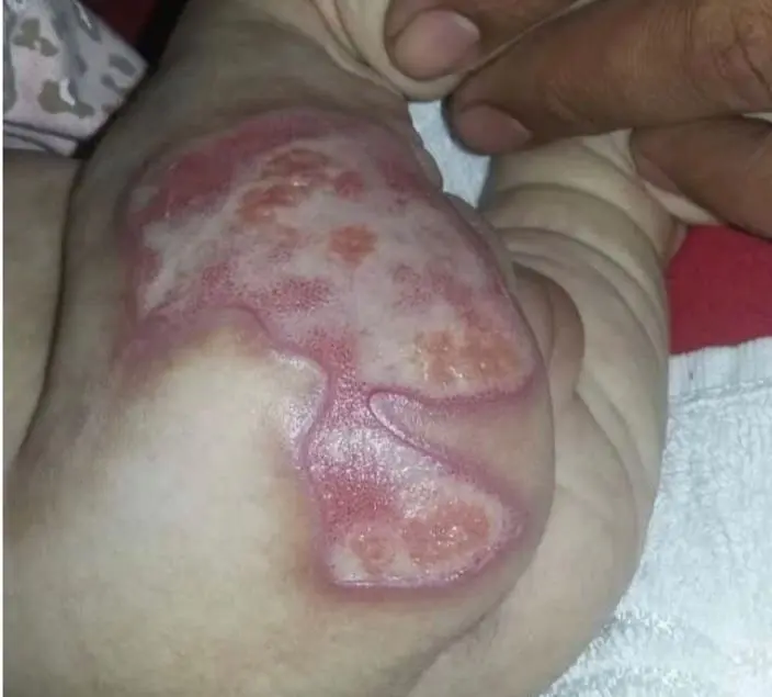 Bebê que sofreu queimaduras em hospital de Anápolis espera Justiça há oito anos: veja por que o processo não anda