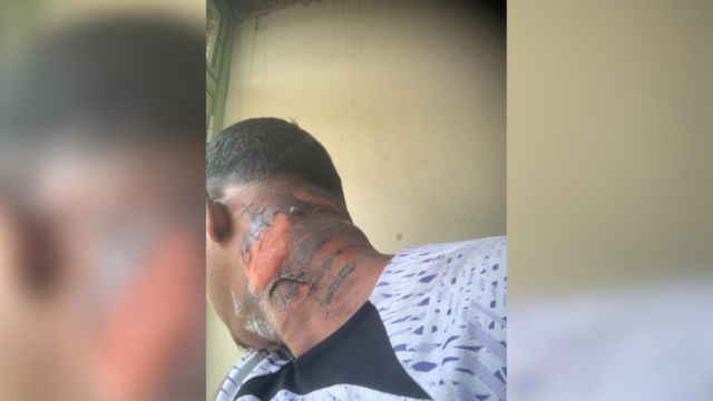 Paciente que teve o corpo incendiado em hospital recebe alta na Barra da Tijuca