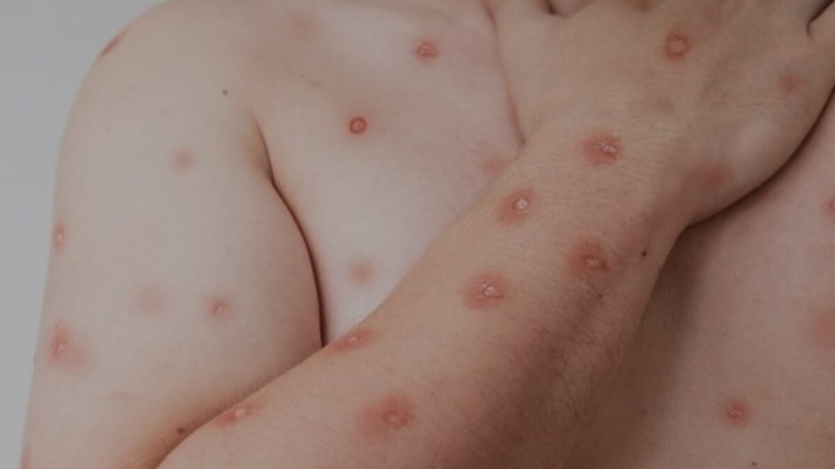 Rio de Janeiro registra alta de casos de Mpox; cidade está sem vacina contra a doença